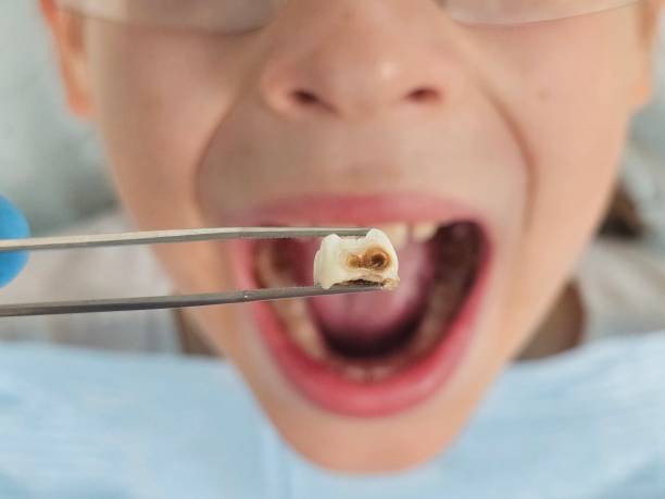 Best Emergency Dental Care for Broken or Chipped Teeth in East Camden, AR